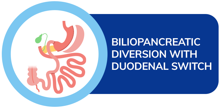 dr amit sood best bariatric surgeon Biliopancreatic Diversion with Duodenal Switch