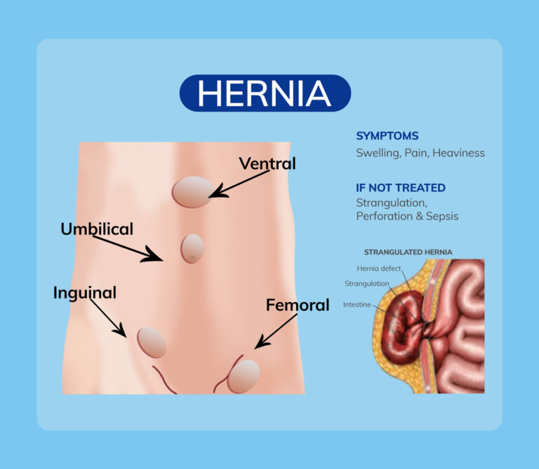hernia dr amit sood best bariatric & laproscopic surgeon in punjab
