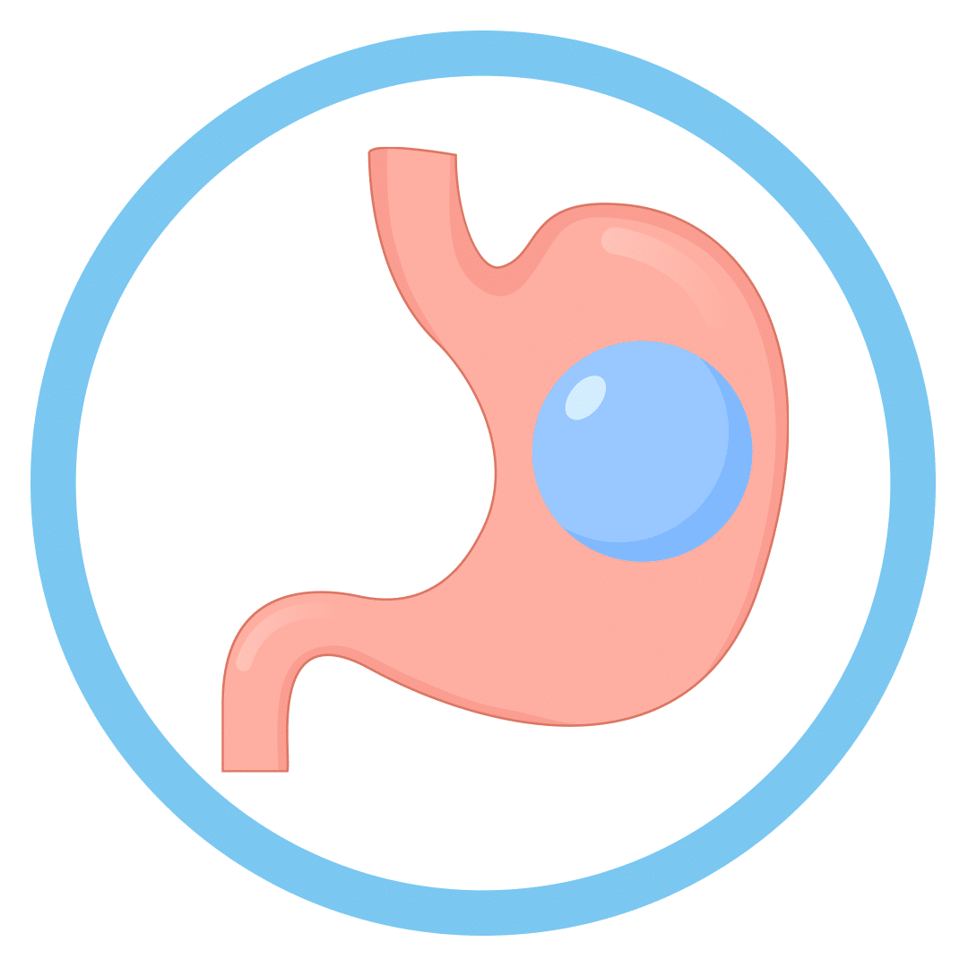 Intragastric Balloon dramitsood