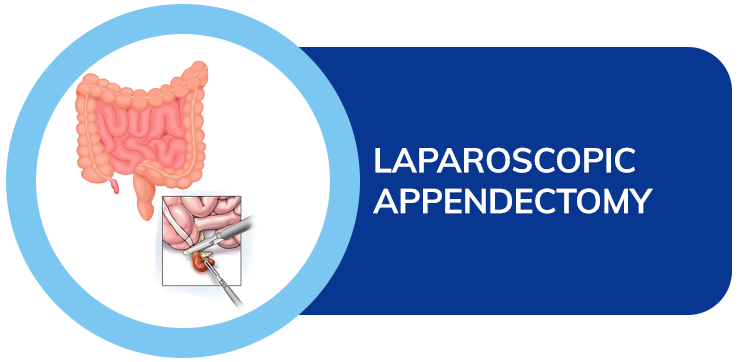 Laparoscopic Appendectomy dr amit sood ckosmic health city