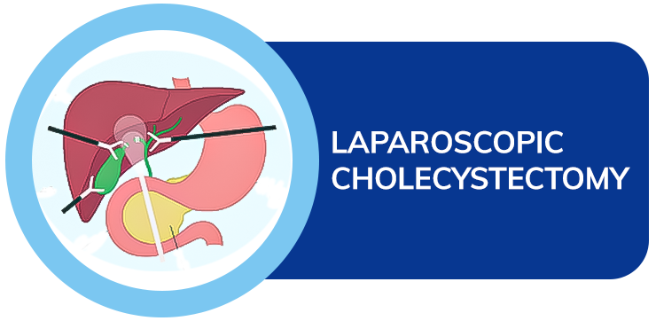 Laparoscopic cholecystectomy dr amit sood best bariatric & laproscopic surgeon in punjab