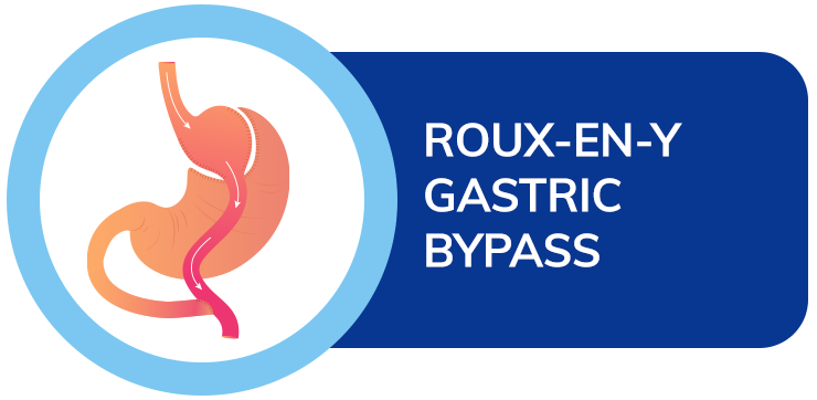 dr amit sood best bariatric surgeon Roux-en-Y gastric bypass surgery
