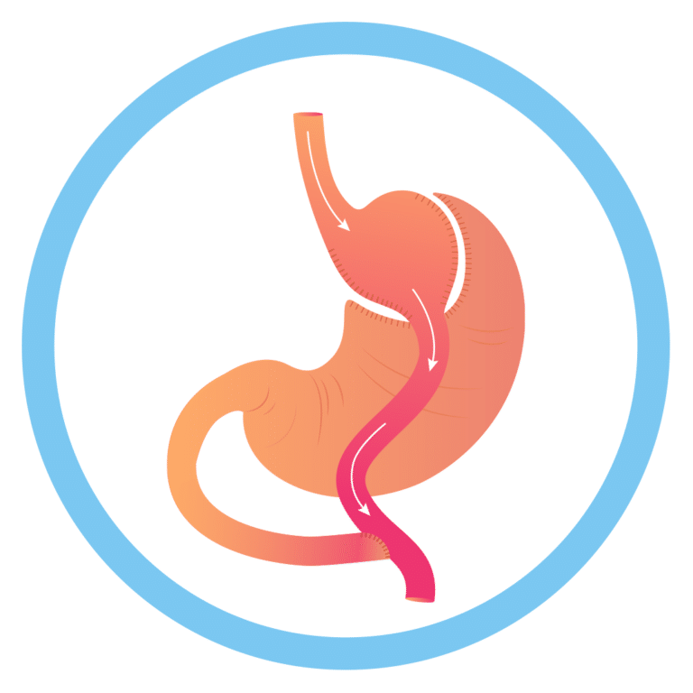 RouxenY Gastric Bypass dramitsood