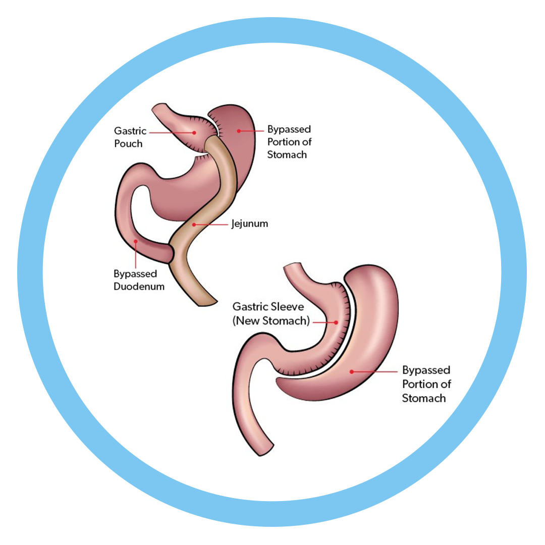 bariatric-surgery-dramitsood