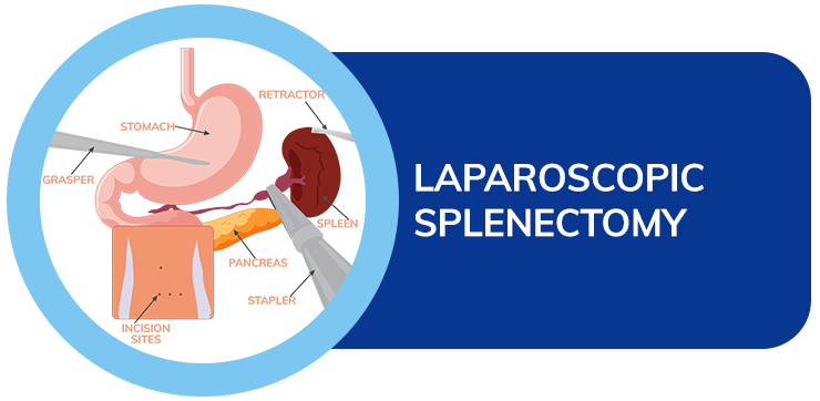 laparoscopic splenectomy dr amit sood best bariatric & laproscopic surgeon in punjab